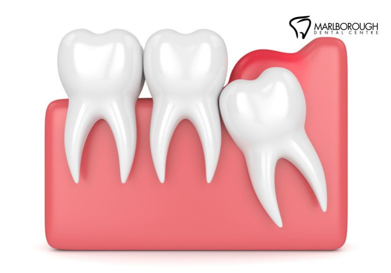 Is Wisdom Teeth Removal Necessary? Signs You Need to See a Dentist